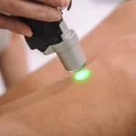 تعداد شات لیزر برای کل بدن و عوامل موثر