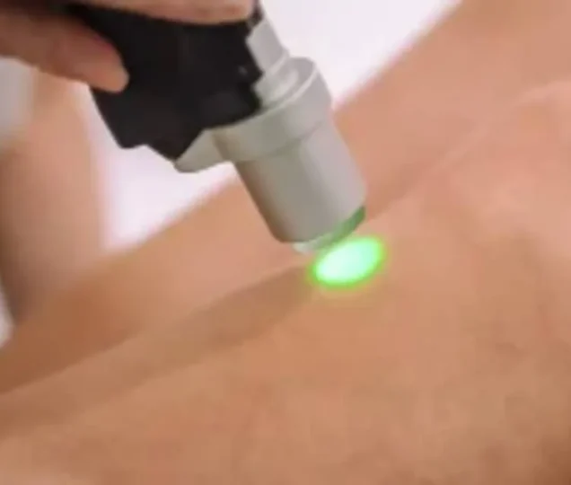 چه تعداد شات لیزر برای کل بدن لازم است؟