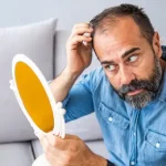 بررسی ریزش مو در بیماران دیابتی توسط متخصص پوست و مو