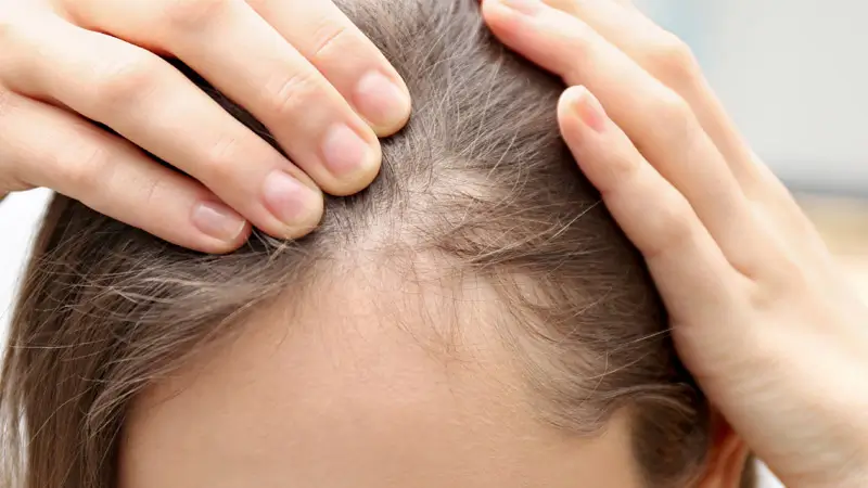 ریزش مو در بیماران دیابتی و نازک شدن مو در زنان