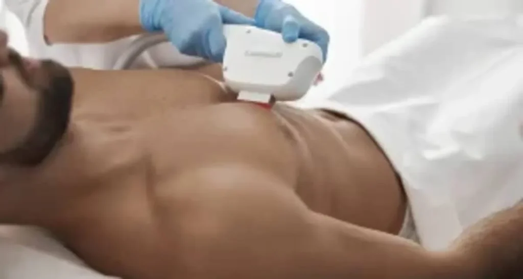 تعداد شات های لیزر برای نواحی مختلف بدن