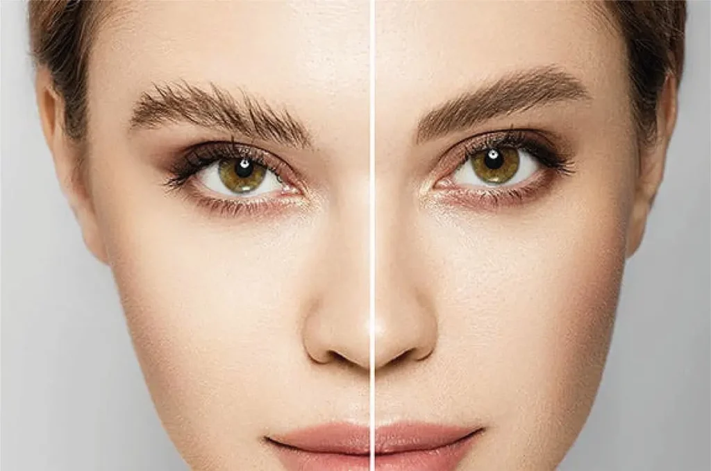 کاشت ابرو برای کسانی که دچار ریزش ابرو ناشی از بیماری هستند