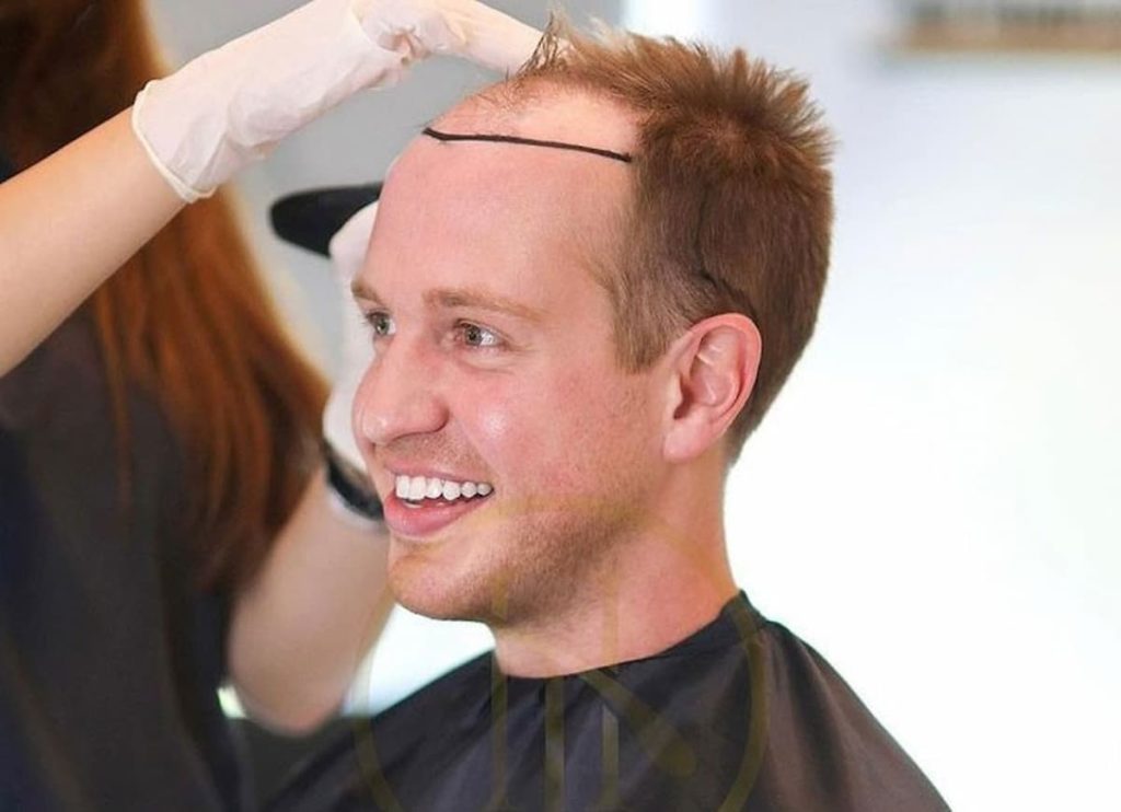 کاشت مو شمال تهران | کلینیک تخصصی دکتر نجف بیگی