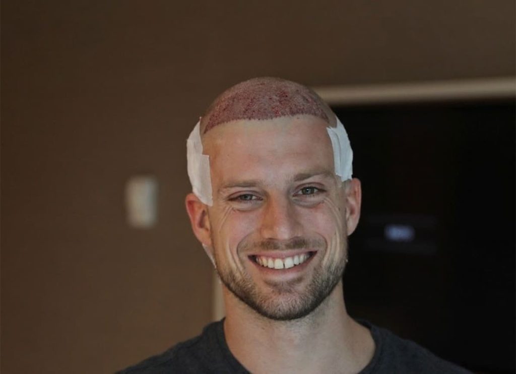 New hair transplant methods and their differences in North Tehran