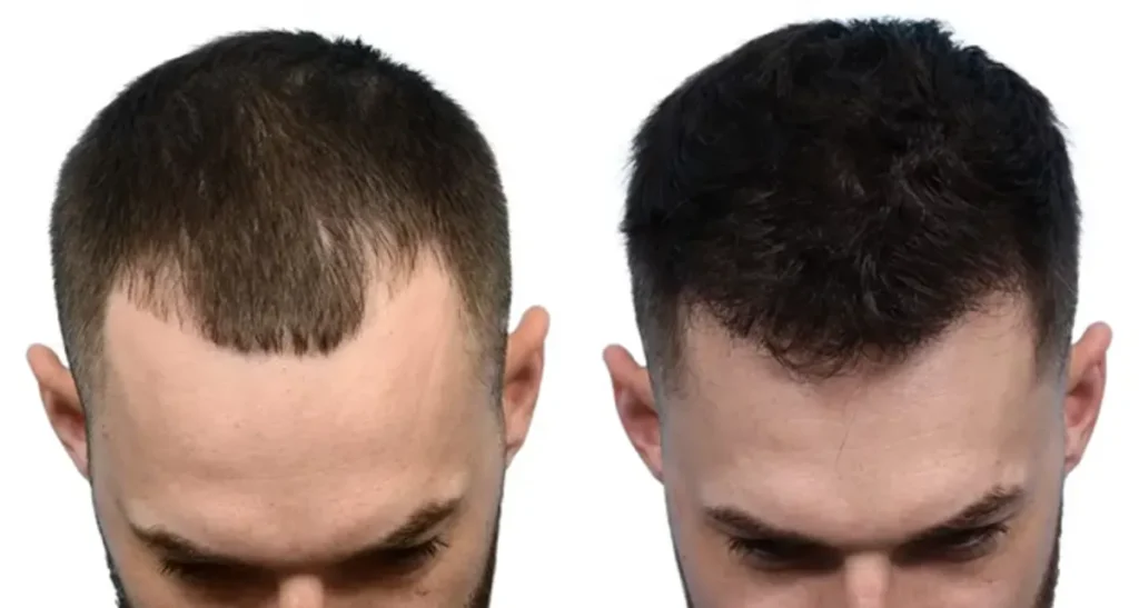 کاشت مو در نیاوران