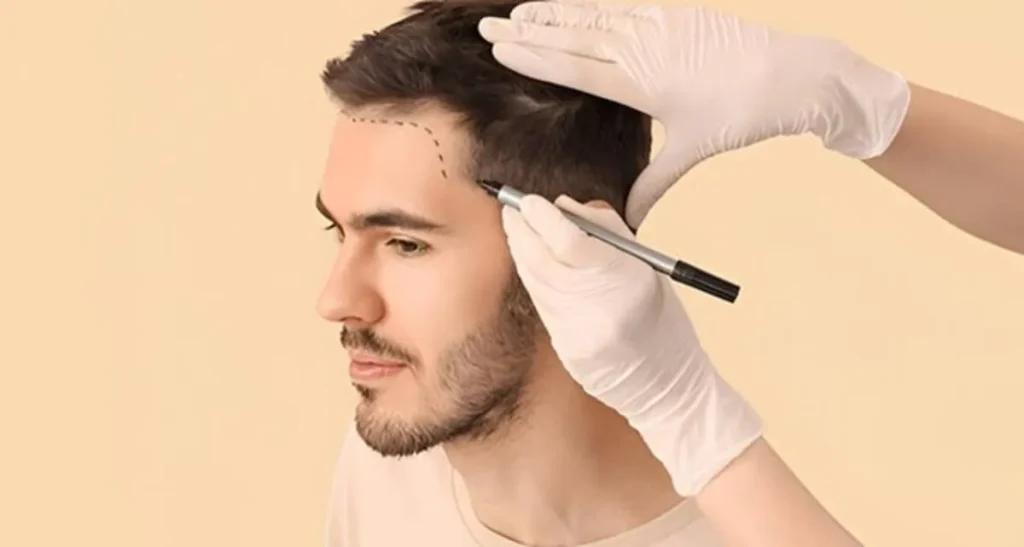 بهترین مرکز کاشت مو طبیعی در نیاوران