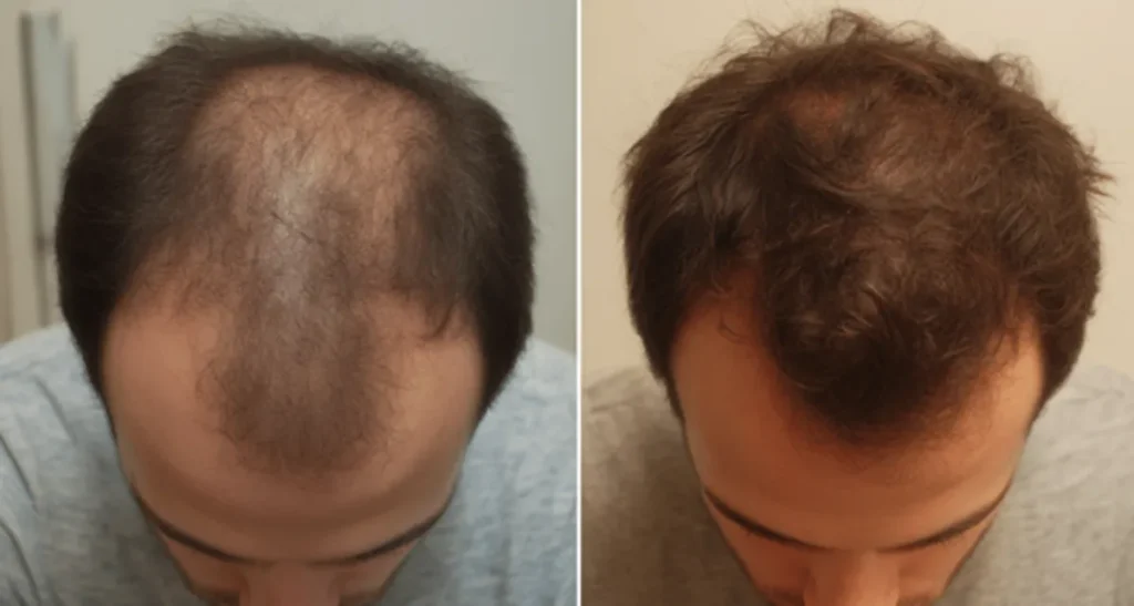 بهترین دکتر کاشت مو در نیاوران