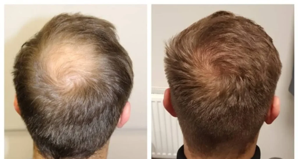 بهترین کلینیک کاشت مو در نیاوران