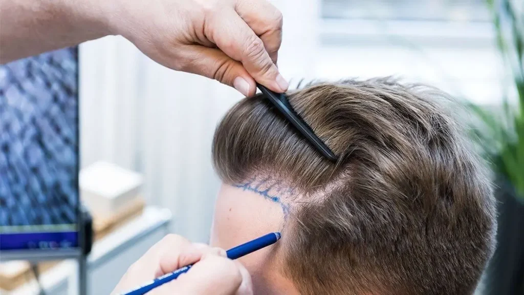 چرا سن مناسب برای کاشت مو 21 سال است؟