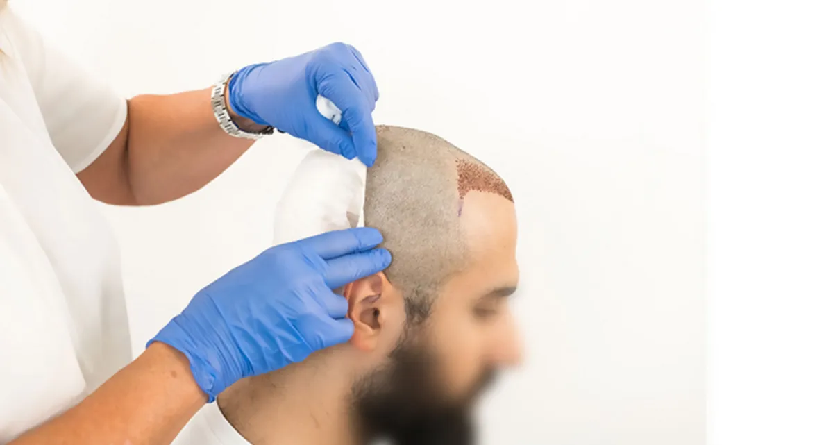 آیا فرد مبتلا به ایدز می تواند کاشت مو کند؟