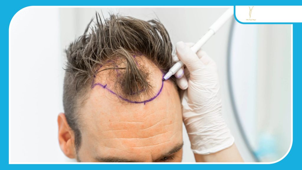 دلایل اصلی عدم موفقیت کاشت مو