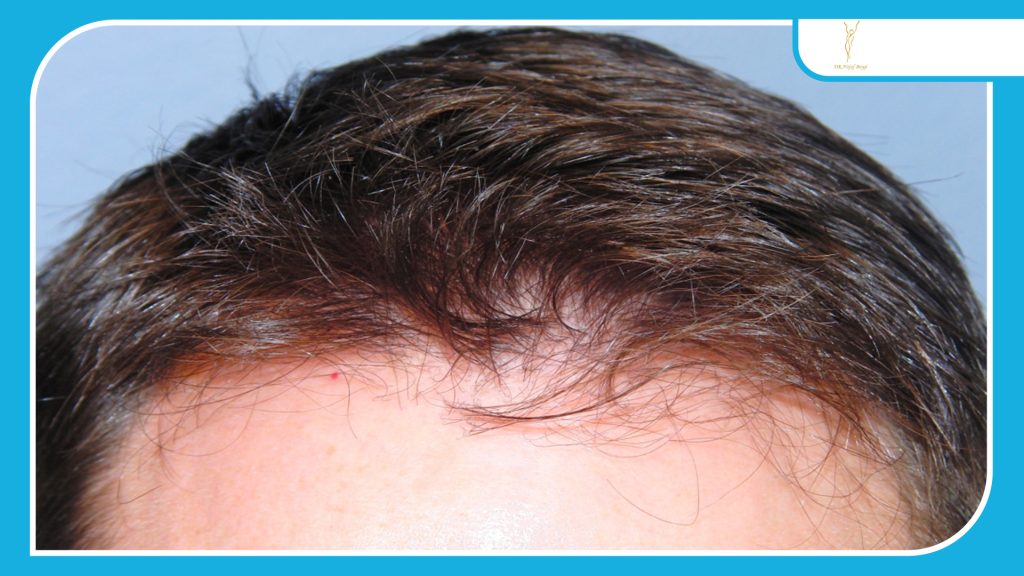 مراقبت های بعد از عمل کاشت مو