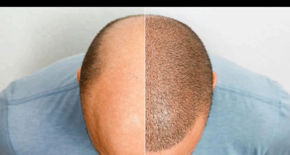 کاشت مو برای افراد مبتلا به HPV