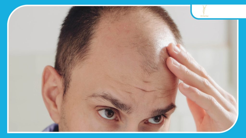 کاندیدای مناسب برای کاشت مو موفق