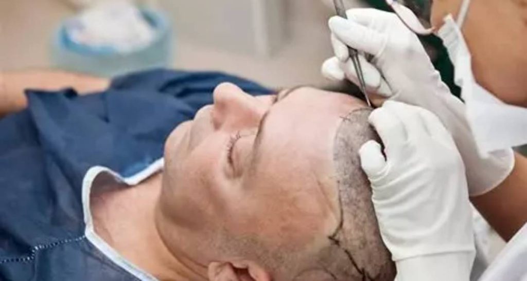 انواع روش‌های کاشت مو