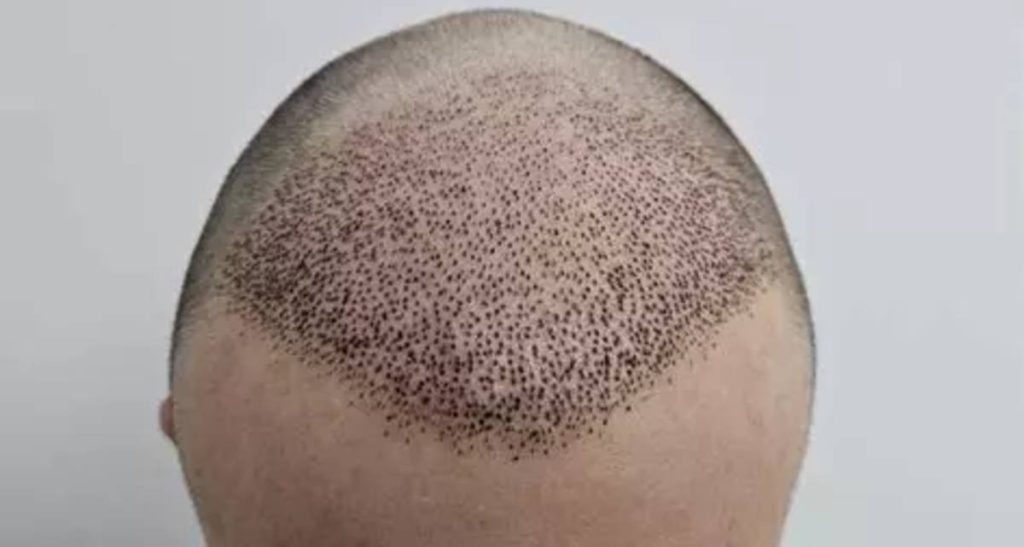 انواع روش کاشت مو