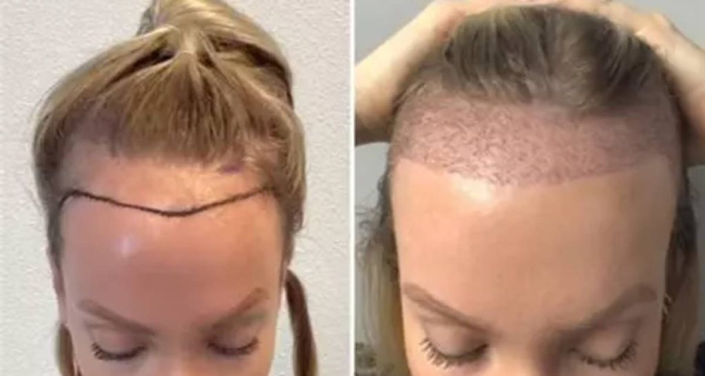 مقایسه روش های کاشت مو در بانوان