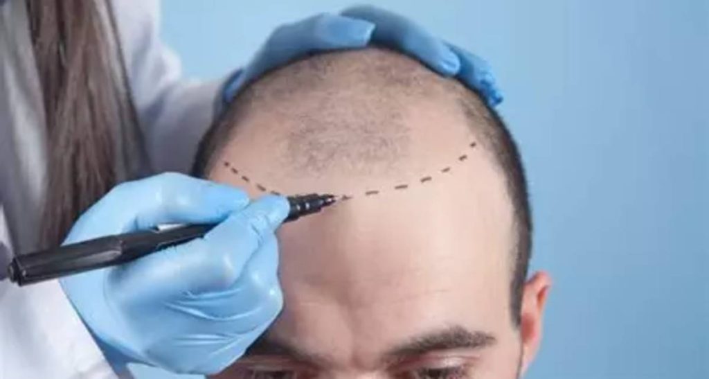 مقایسه کاشت مو به روش های مختلف