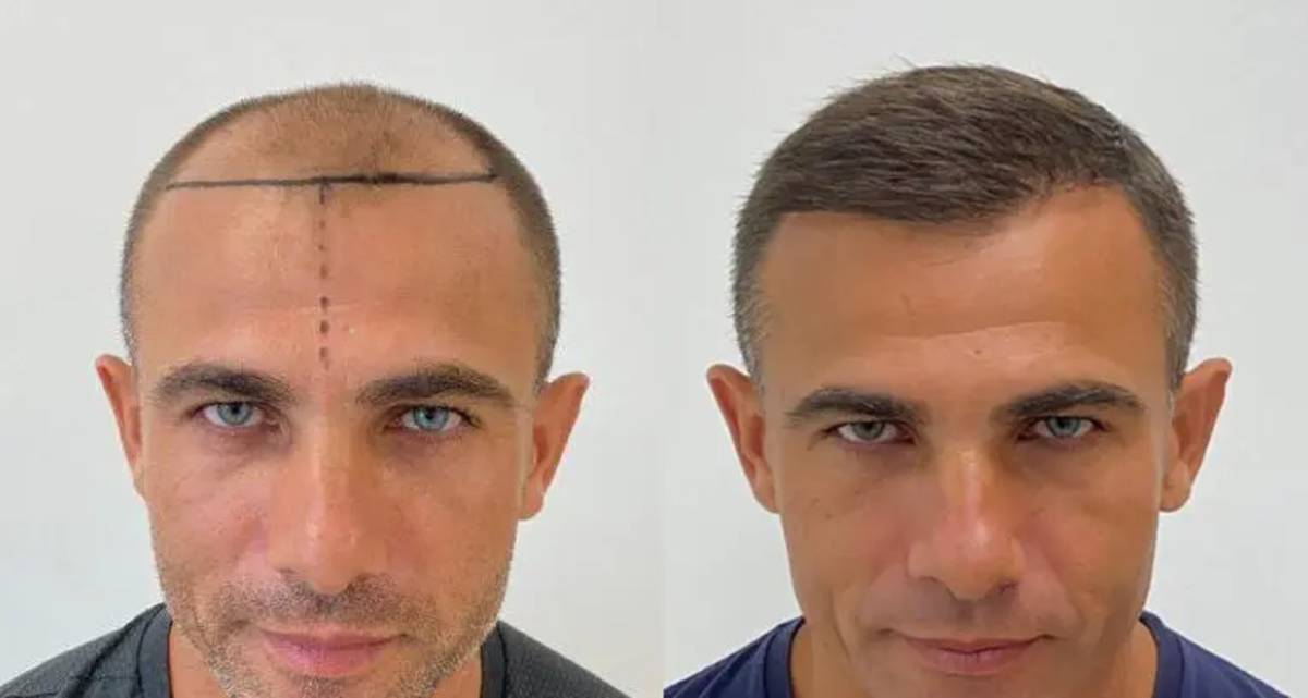 کاشت مو چقدر زمان می‌برد