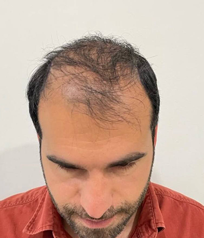 قبل کاشت مو