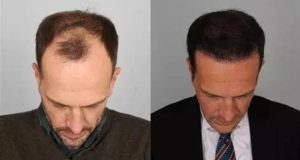 مقایسه روش های کاشت مو