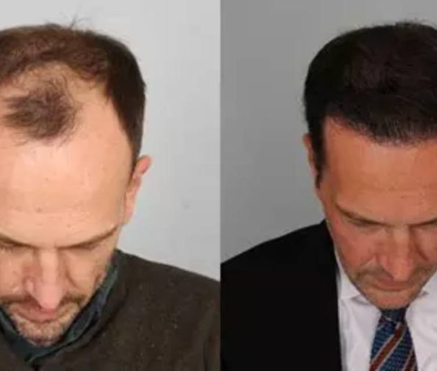 مقایسه روش های کاشت مو