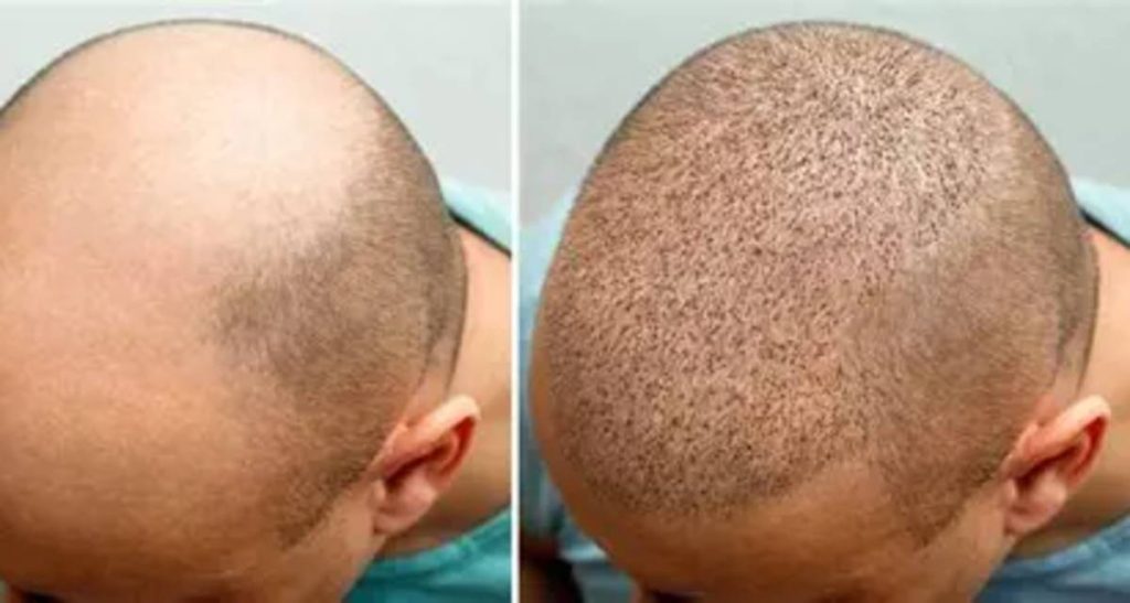 بررسی مزایا و معایب انواع روش کاشت مو