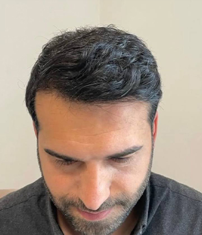 بعد کاشت مو