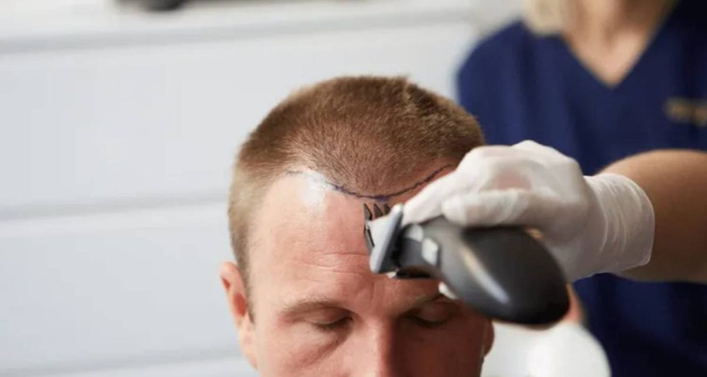 مقایسه انواع روش های کاشت مو