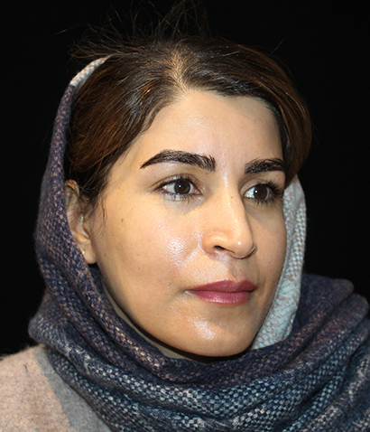 بعد از کاشت ابرو