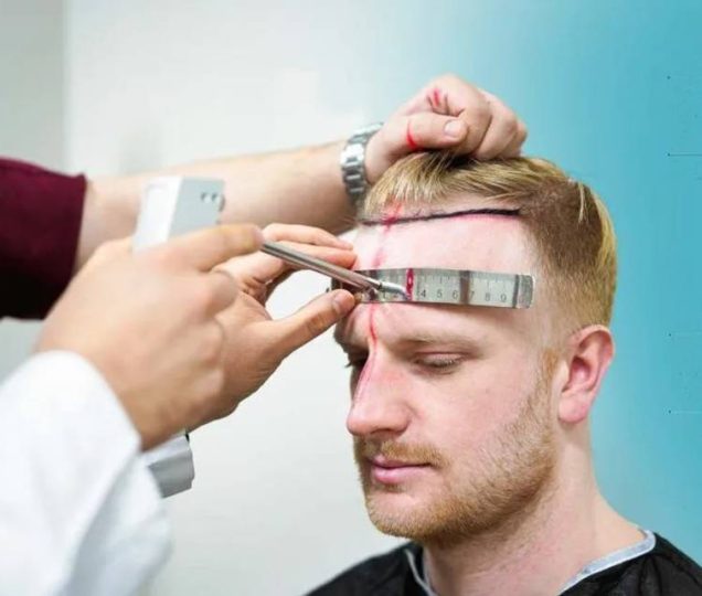 کاشت مو چند ساعت طول می کشد؟