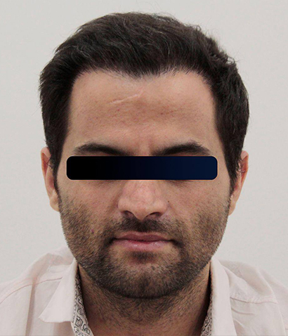 مو کاشت