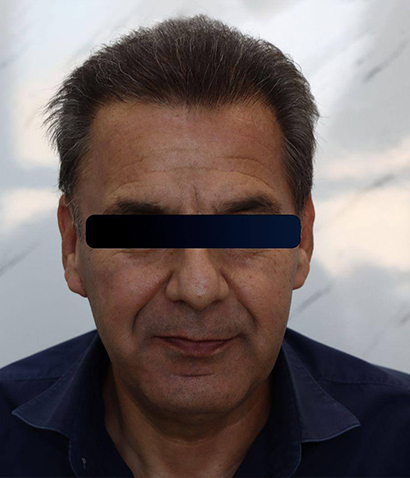کاشت مو