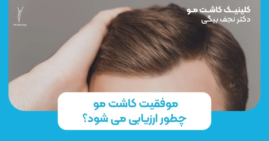 موفقیت کاشت مو چطور ارزیابی میشود؟