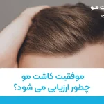 موفقیت کاشت مو چطور ارزیابی میشود؟