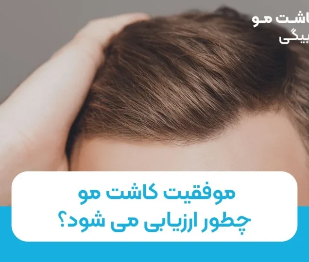 موفقیت کاشت مو چطور ارزیابی میشود؟