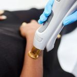 لیزر موهای زائد برای نوجوانان؛ از چه سنی شروع کنیم؟