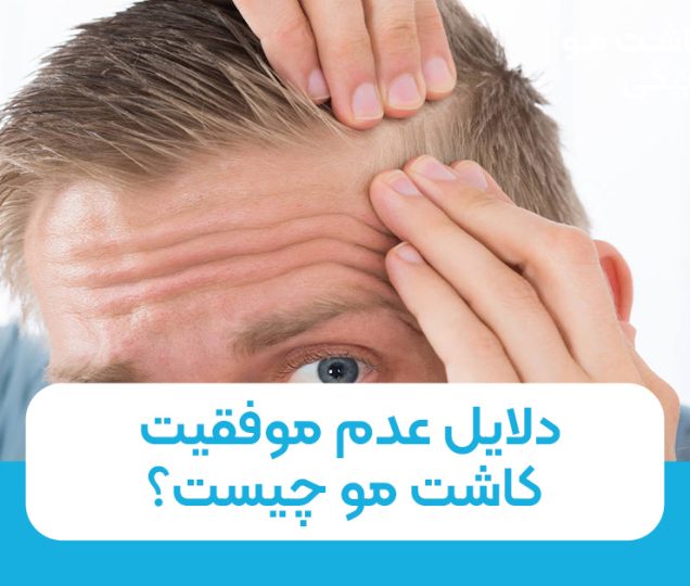 دلایل عدم موفقیت کاشت مو چیست؟