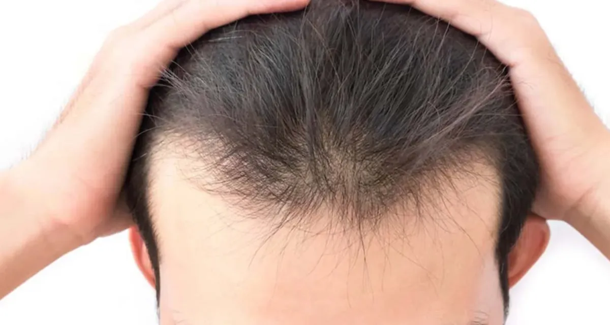 آشنایی با جدیدترین روش کاشت مو