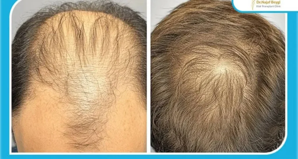 بالاترین تراکم کاشت مو