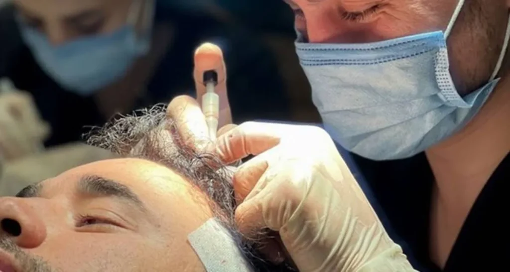 بهترین روش کاشت مو با تراکم بالا چیست