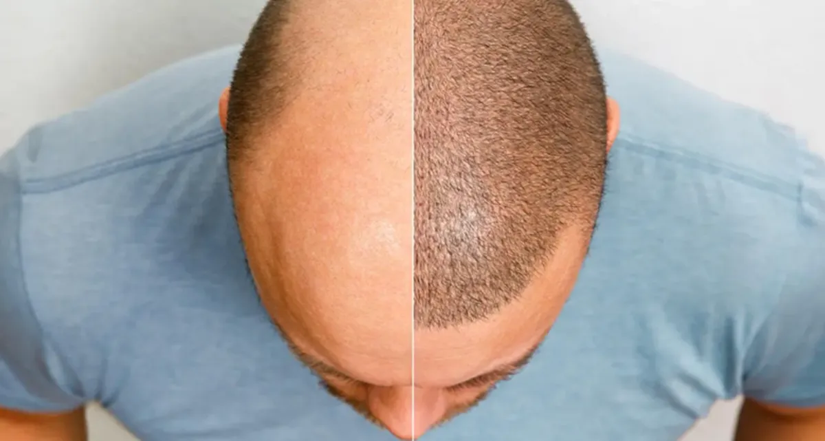 جدیدترین روش کاشت مو