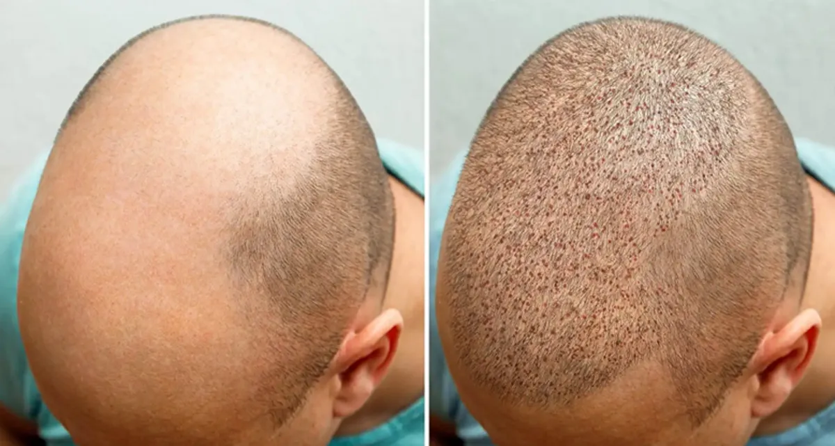 جدیدترین و پیشرفته ترین روش کاشت مو