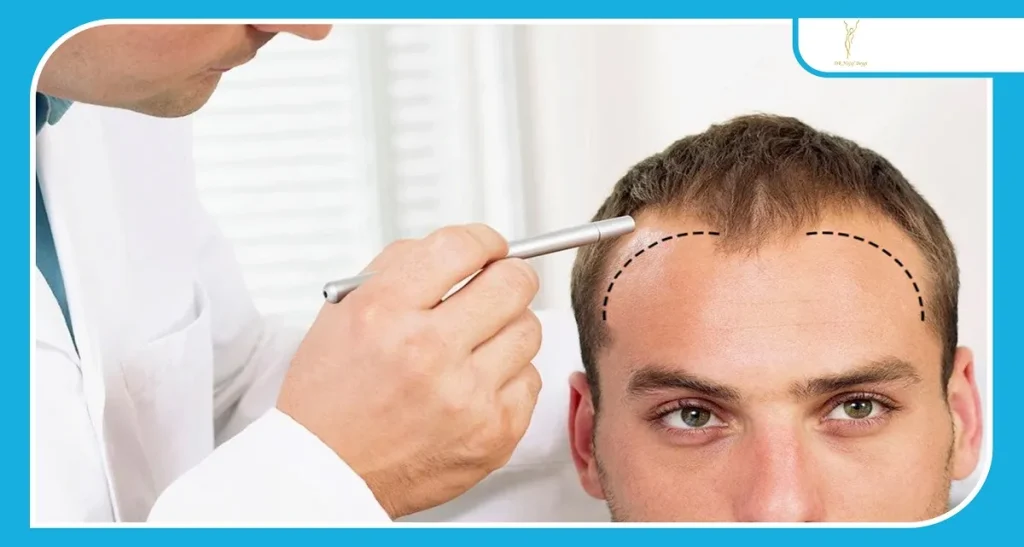 احکام شرعی کاشت مو در شرایط گوناگون