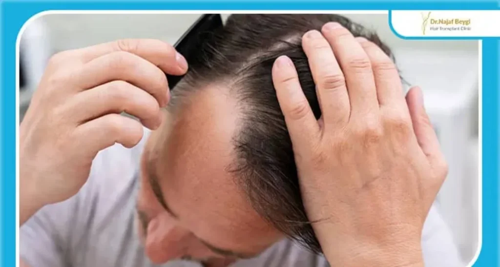 کاشت مو با تراکم بالا در تهران