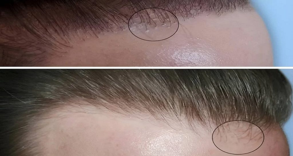 کاشت مو برای بیماران پسوریازیس