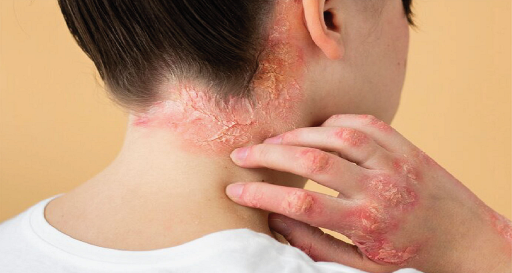 کاشت مو برای بیماران پسوریازیس