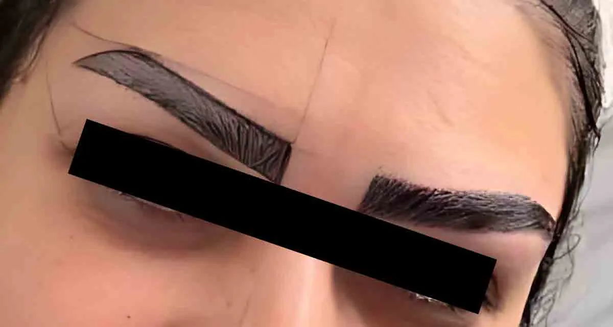 عکس قبل و بعد کاشت ابرو بدون جراحی