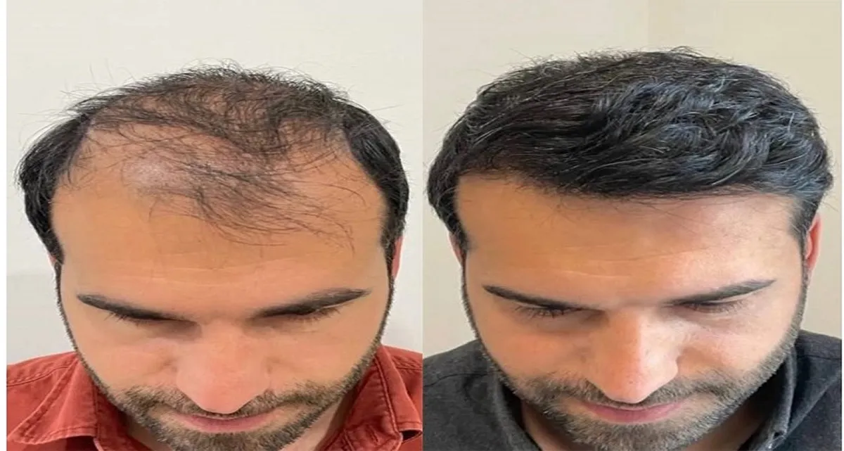 قبل و بعد کاشت مو به روش fue 