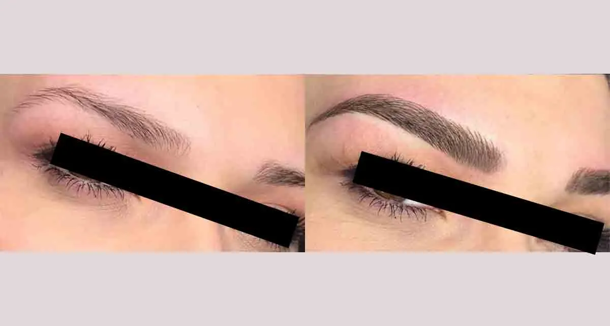 عکس قبل و بعد کاشت ابرو به روش FUE